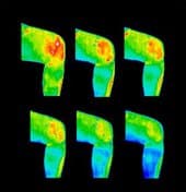 Sample thermogram of a knee, monitoring the effects of acupuncture