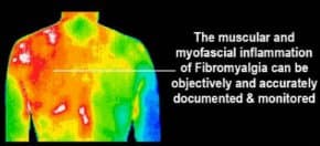 Sample thermogram showing thermal imaging patterns